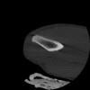 SPORK, NICO - 22.03.1976 - 02.08.2022 - CT obere Extremität - 17:51:17